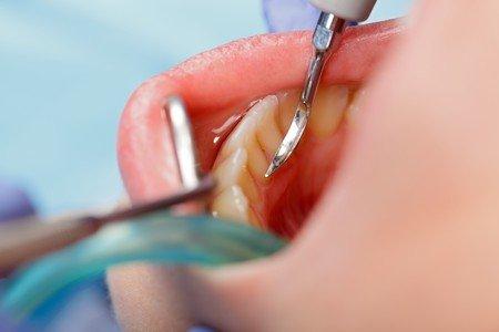 Parodontitis als eine der Hauptursachen für Zahnverlust
