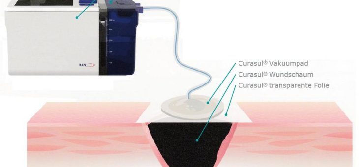Entwicklung der Curasul Therapieeinheit für die Unterdruck-Wundversorgung