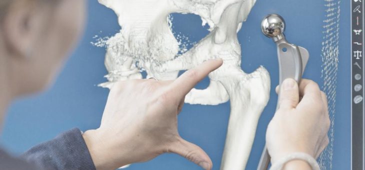 Einblicke in die Endoprothetik von Hüfte und Knie – modiCAS-Blog