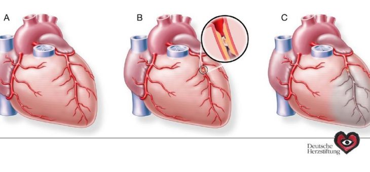 Herzinfarkt bei Frauen: Bauchschmerzen können ein Warnzeichen sein