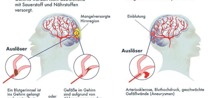 Schlaganfall: Jeder fünfte bleibt rätselhaft