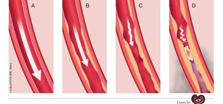 Schmerzen in den Beinen können Warnsignal für Herzinfarkt und Schlaganfall sein