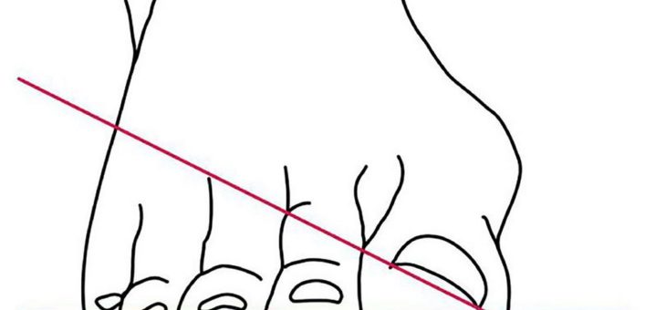 „Hallux valgus“ – Das schmerzhafte Problem mit dem großen Zeh