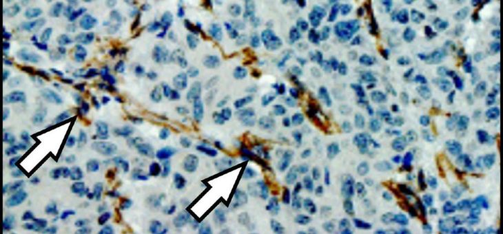 Wechselwirkungen zwischen Tumor- und Bindegewebszellen fördern Metastasenbildung