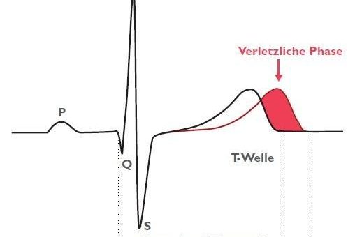 Warnung vor vorzeitigem Einsatz von Chloroquin-Azithromycin-Kombinationstherapie gegen COVID-19-Infektionen: Risiko durch bösartige Herzrhythmusstörungen