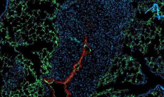Metastasierung verhindern – ein Antikörper mit Potenzial