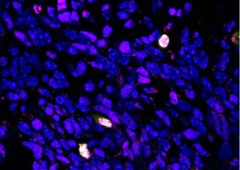 Gendefekt beeinflusst Tumorentwicklung in kindlichen Hirntumoren
