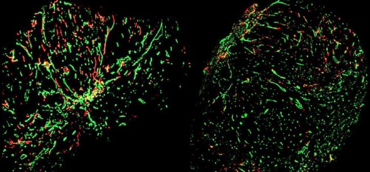 Wie sich die Ausbreitung von Tumorzellen über die Lymphgefäße verhindern lässt