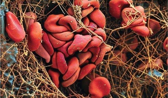 Positives CHMP-Votum für Rivaroxaban zur Behandlung von Kindern mit venösen Thromboembolien (VTE)