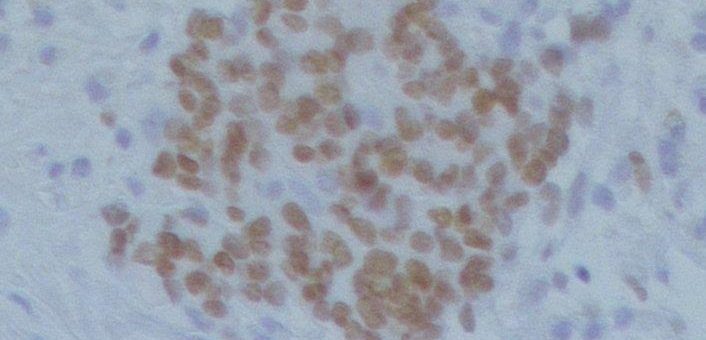 Krebs bei Kindern: Molekulare Super-Verstärker entscheiden über Verlauf von Neuroblastomen