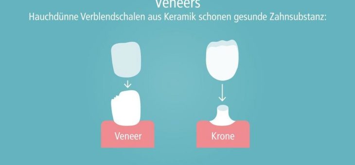 Zahn-Veneers: Wann sind sie sinnvoll?