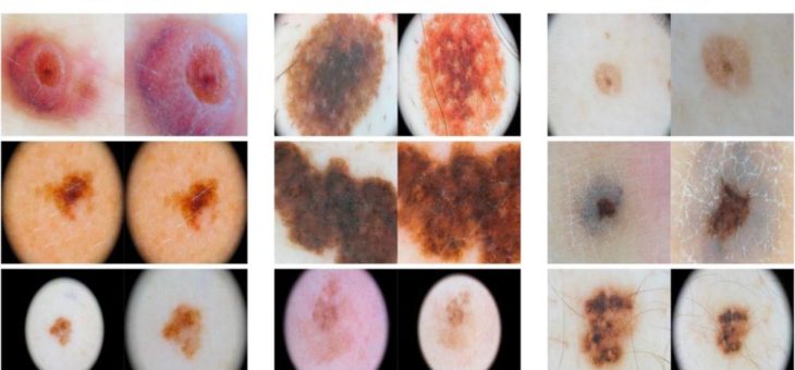 Künstliche Intelligenz zur Diagnose von Hautkrebs: Expertenblick nach wie vor unverzichtbar