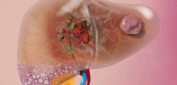 Leberkrebs: Bei welchen Patienten wirkt die Immuntherapie?