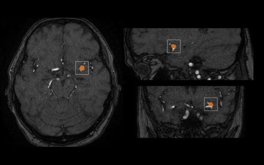 mediaire führt mit mdbrain weltweit ersten neuroradiologischen KI-Assistenten mit vollautomatischer Detektion von Aneurysmen ein