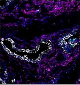 Warum identische Mutationen unterschiedliche Krebsarten auslösen