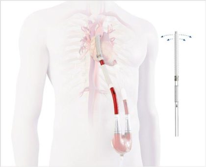 Berlin Heart gibt CE-Kennzeichnung und erste Implantation der neuesten Kanülen-Generation zur Behandlung von Herzpatienten bekannt