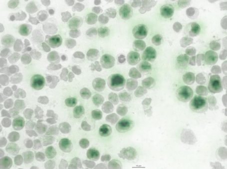 Künstliche Intelligenz hilft bei Leukämie-Diagnose