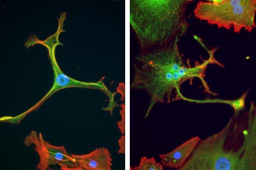Therapieresistenz von Krebs überwinden: Knochen- und Weichteiltumoren bei Jugendlichen als Modellsystem