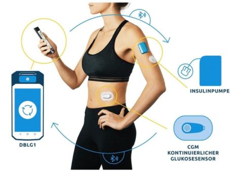 Erleichterung für Typ 1 Diabetiker – Gothaer Kranken kooperiert als erste PKV mit Diabeloop