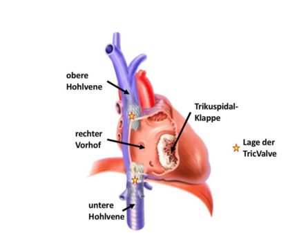 Neuartige Katheter-Herzklappe erstmalig in Nordrhein Westfalen implantiert
