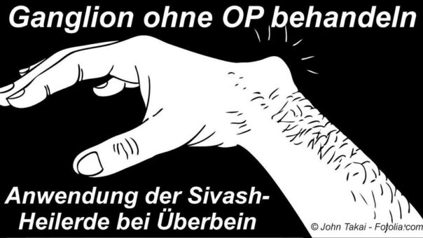 10 Jahre Erfahrung in der Ganglion-Behandlung mit Sivash-Heilerde