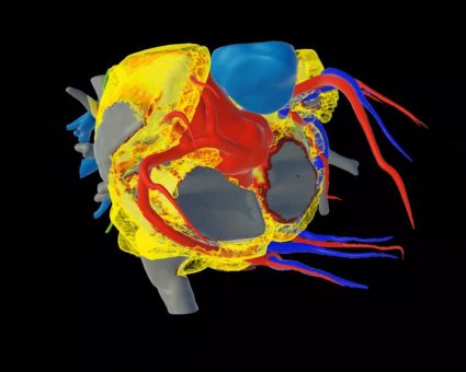 Ablation bei Vorhofflimmern: Verringert zu viel Herzfettgewebe den Therapieerfolg?