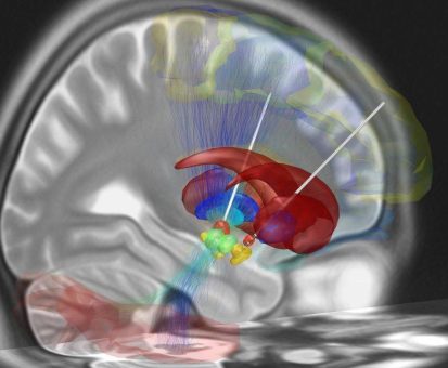 Ein Jahr nach meiner tiefen Hirnstimulation