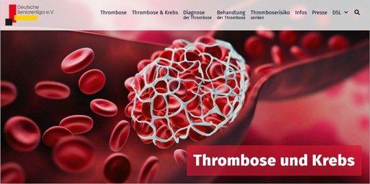 Krebserkrankung birgt hohes Risiko für Venenthrombose