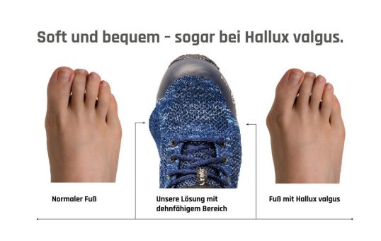 Baak präsentiert bequeme Lösung bei Hallux valgus