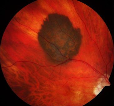 Neuartige Immuntherapie für fortgeschrittenes Melanom des Auges