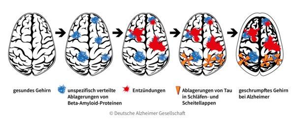 Was passiert bei Alzheimer im Gehirn?