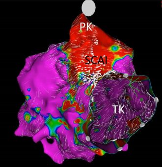 3D-Herz-MRT: Diagnose gefährlicher Rhythmusstörungen ohne Herz-Katheter