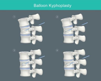 Osteoporose & Wirbelkörperbruch