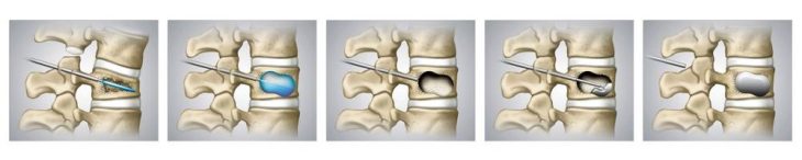 Die besten Therapieoptionen bei einem Wirbelkörperbruch