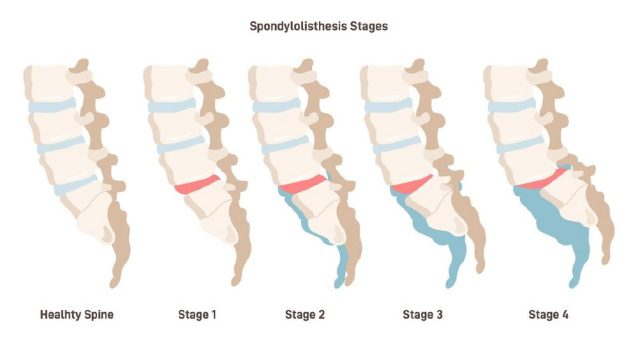 Wirbelgleiten richtig diagnostizieren und effektiv behandeln