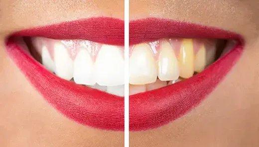 Gelbe Zähne vermeiden: Ursachen verstehen, Verfärbungen sanft vorbeugen