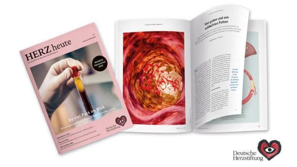 Gefäßkiller LDL-Cholesterin: Sind Butter, Eier, Käse Übeltäter?