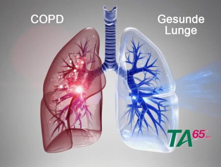 Innovativer Wirkstoff TA-65® schützt vor Lungenschäden durch Zigarettenrauch – neue Perspektiven für COPD-Prävention
